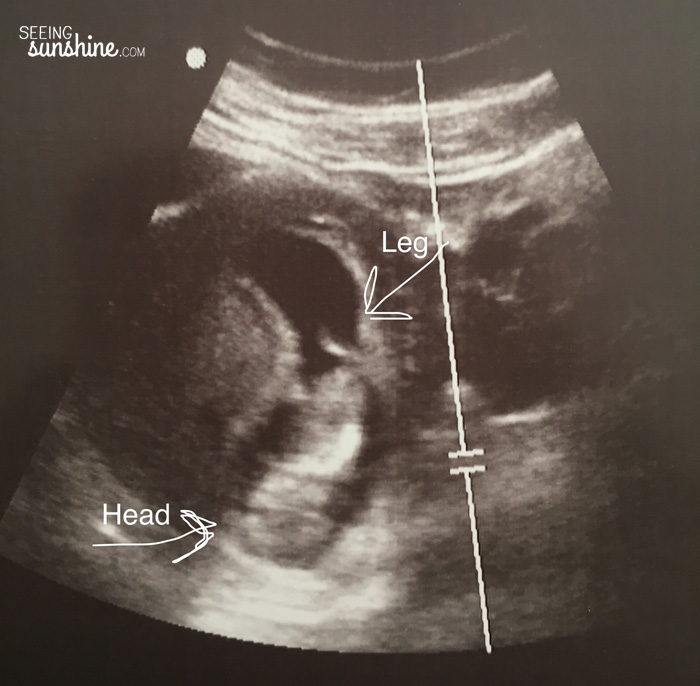 Our Second Ultrasound at 10 weeks