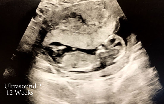 Here is baby #2 at 12 weeks.