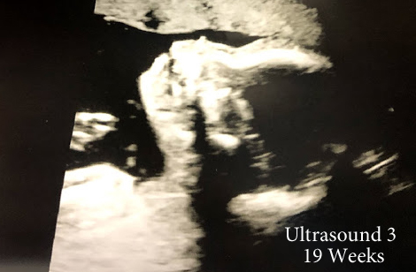 Here's baby #2 at 19 weeks. 